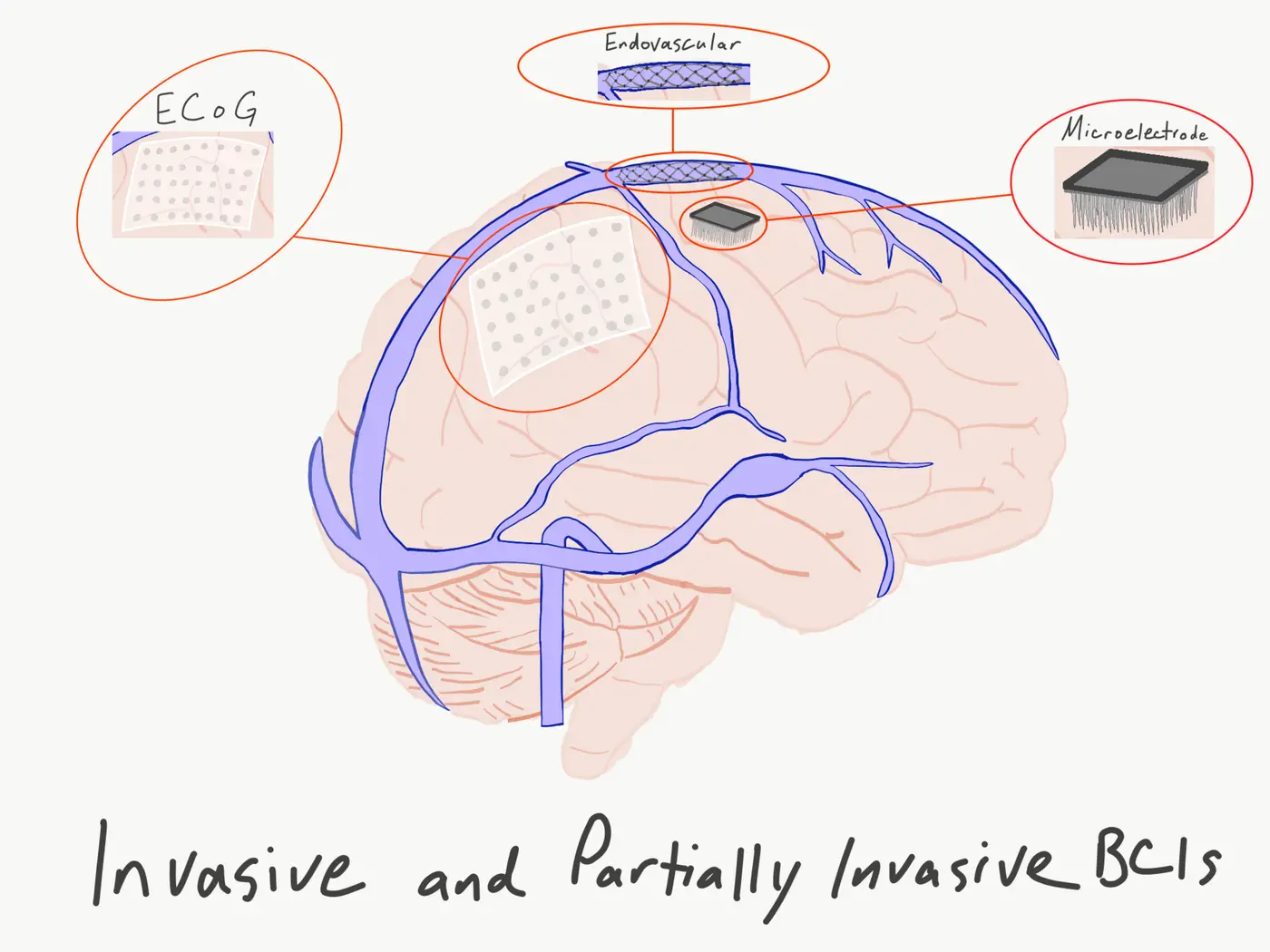 Neuralink · el implante cerebral entra en producción